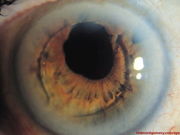 Intraocular Lens (IOL), Anterior Chamber