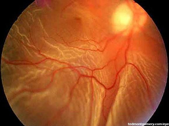Retinal Detachment: #5