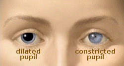 dilated and constricted pupils
