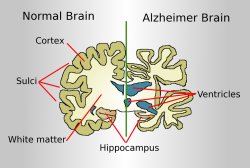 Normal brain and Alzheimer brain